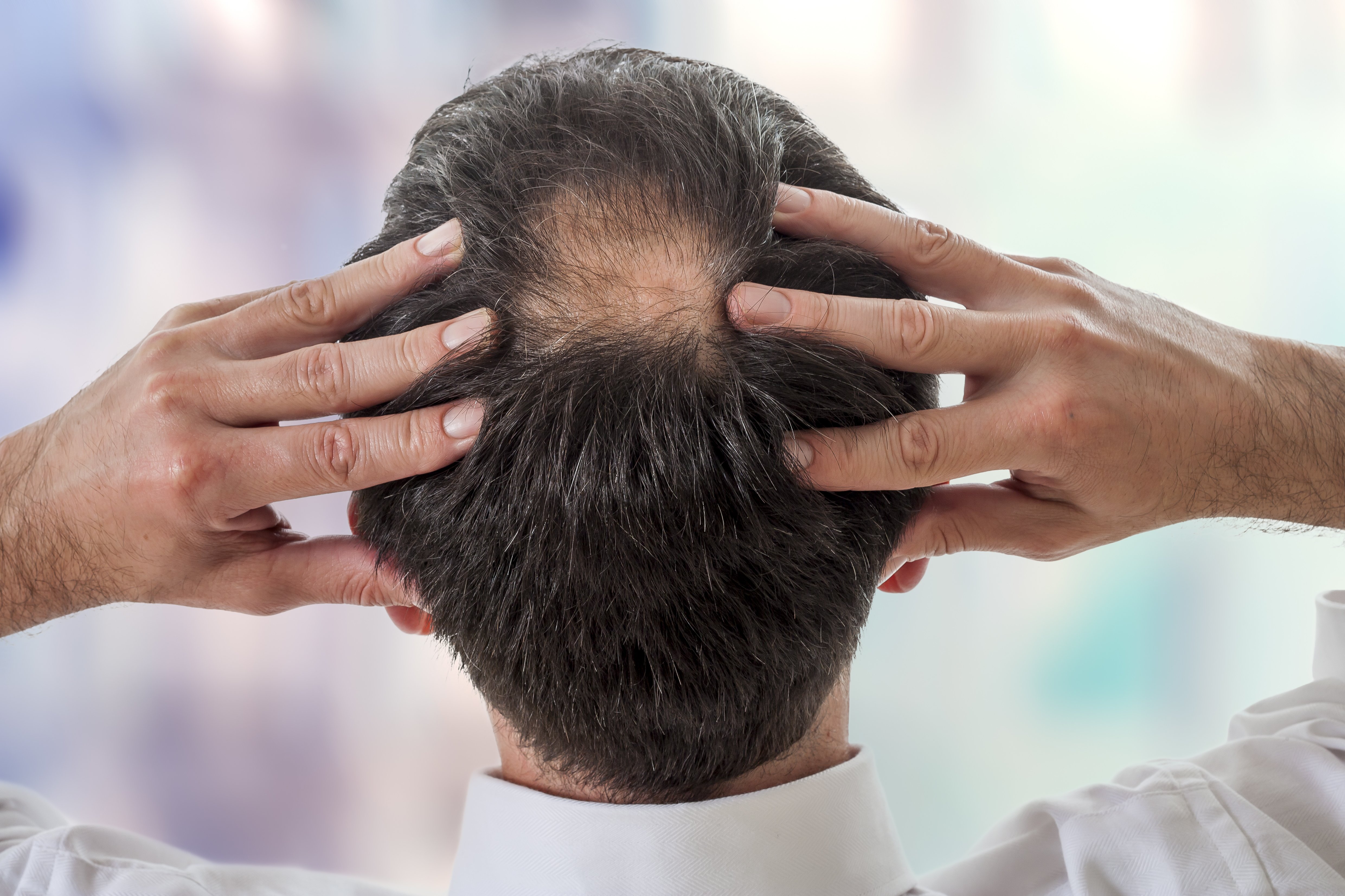 Male Pattern Baldness: Stages, Symptoms & Prevention | Clinikally