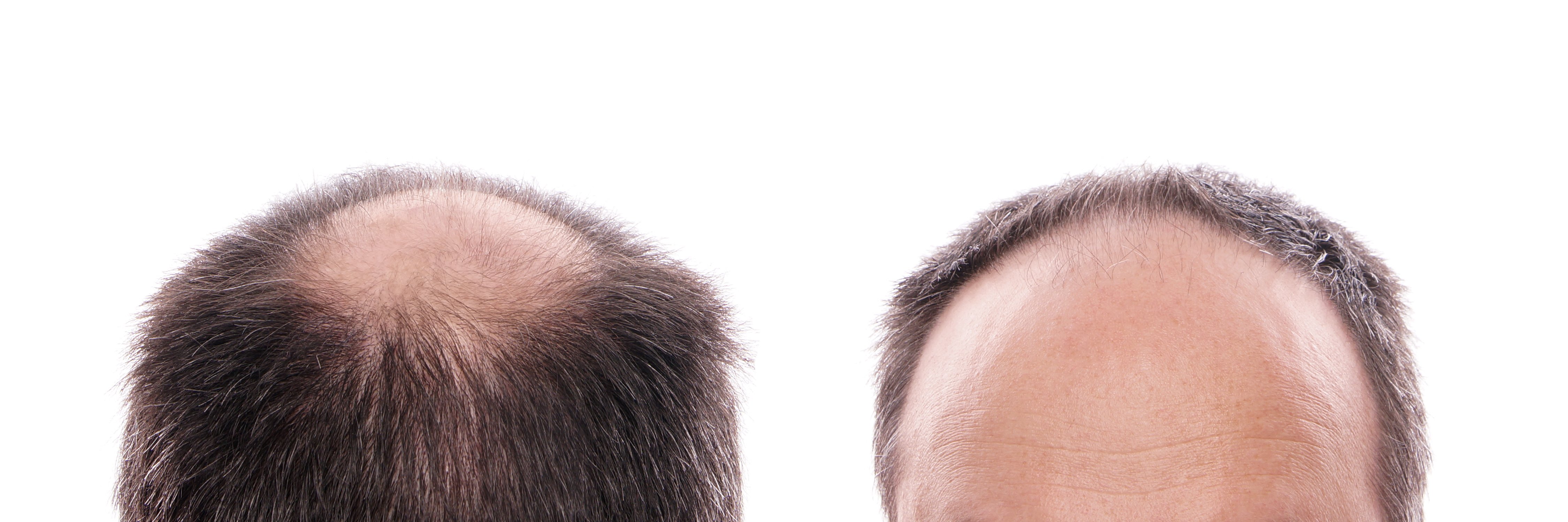 Does Finasteride Cause Shedding? | Assured Pharmacy