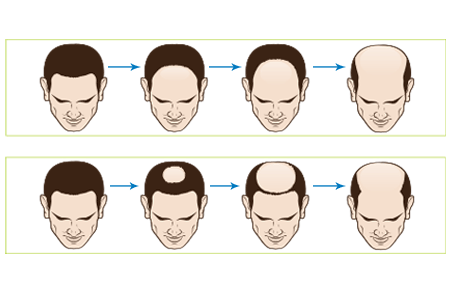 Male Hair Loss Progression